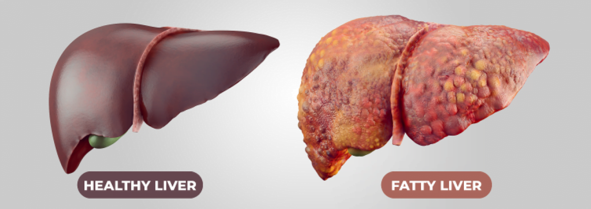 Healthy and Fatty Liver