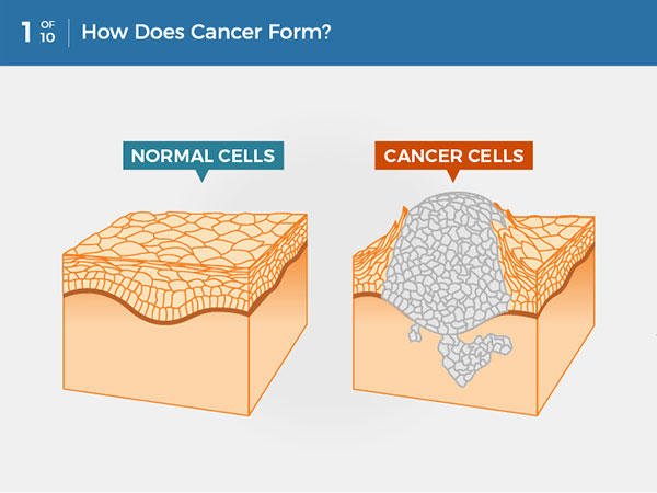 Cancer Stages